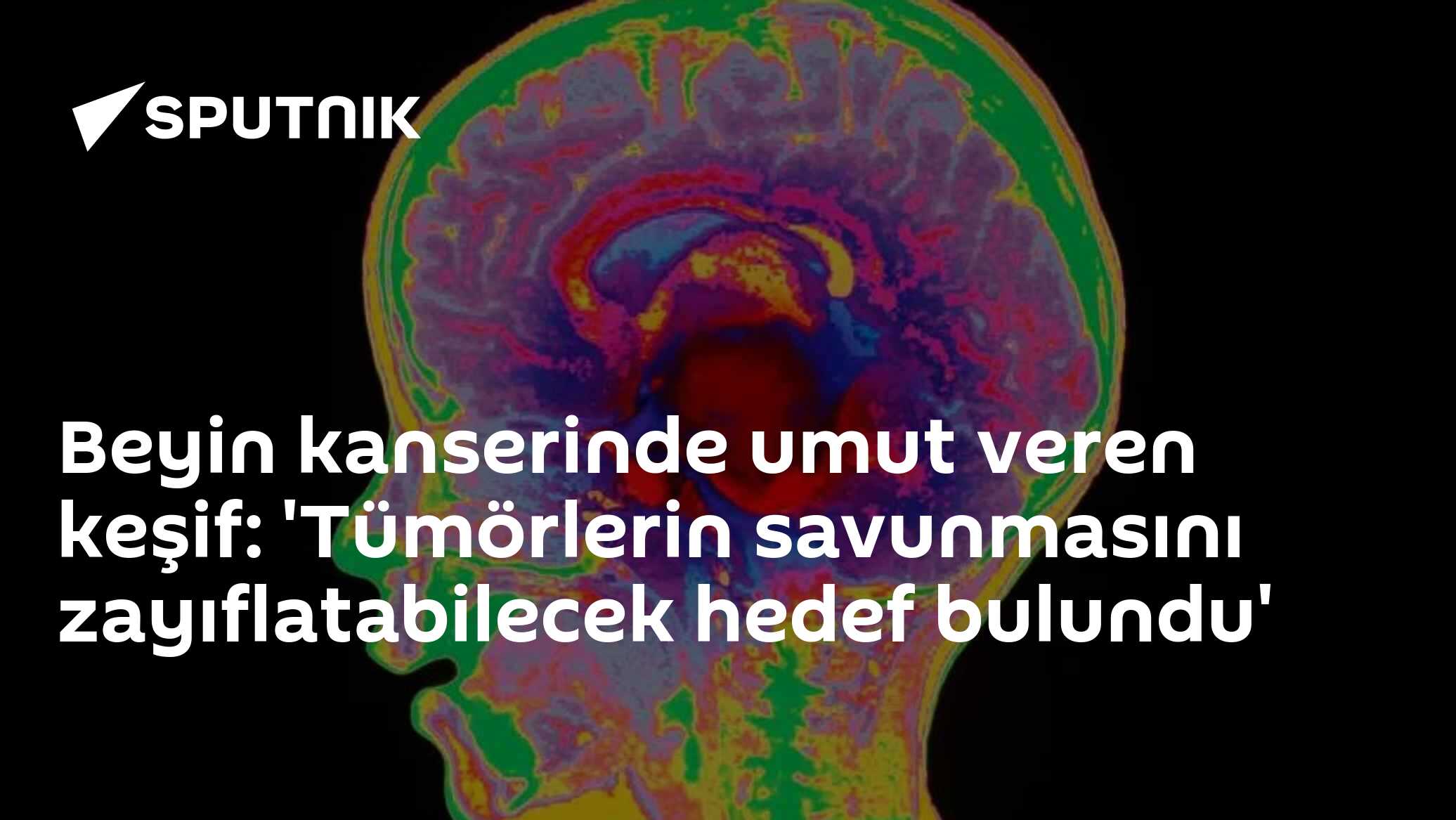 Beyin Tümörlerinin Tedaviye Direncini Kıracak Yeni Hedef Keşfedildi