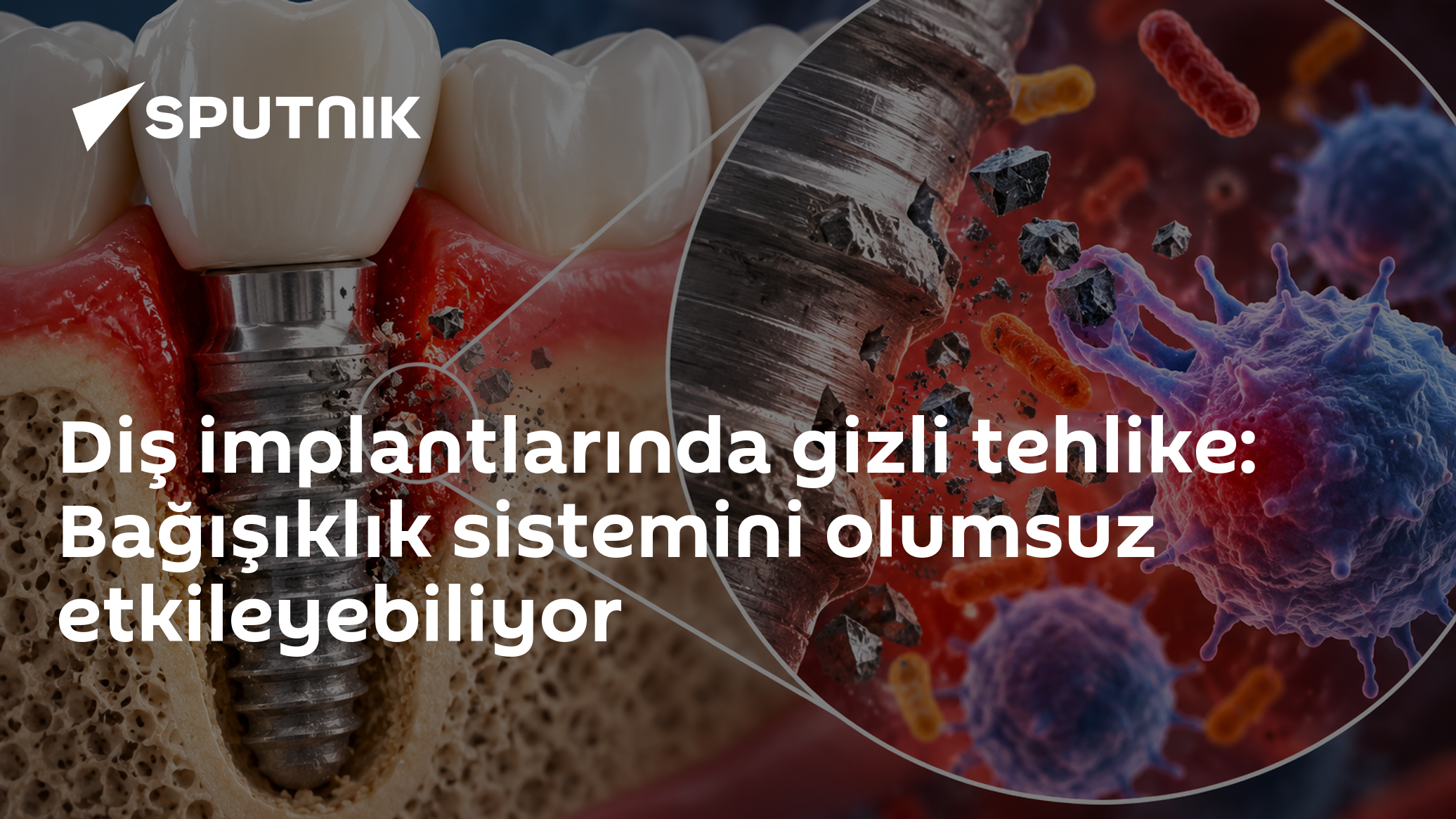 Diş implantlarından ayrılan titanyum parçacıkları bağışıklık sistemini nasıl etkiliyor?
